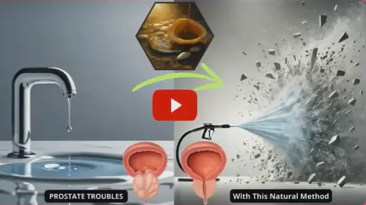 Dr. Burke Prostate Study Video Presentation